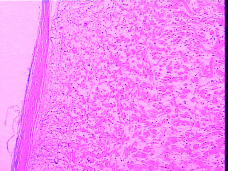 腹壁一个包块，巨检长相很似神经鞘瘤，不知是什么东东图2