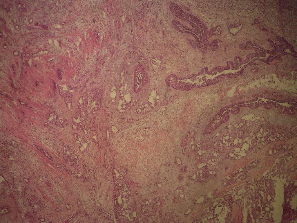 腺病？癌？其他？(12楼常规，24楼免疫组化及会诊结果)图1