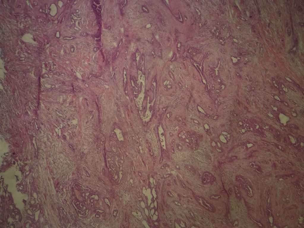 腺病？癌？其他？(12楼常规，24楼免疫组化及会诊结果)图2