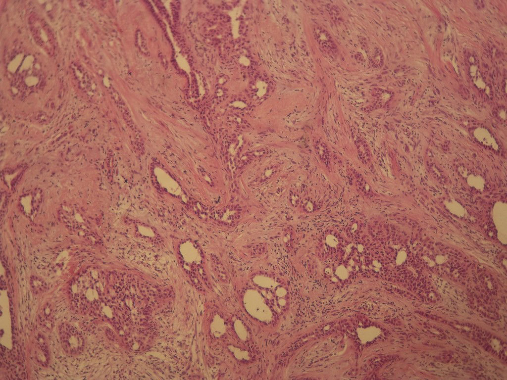 腺病？癌？其他？(12楼常规，24楼免疫组化及会诊结果)图3