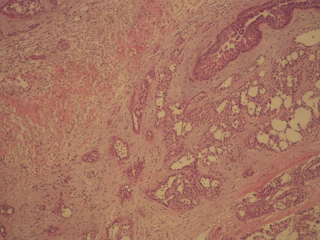 腺病？癌？其他？(12楼常规，24楼免疫组化及会诊结果)图6