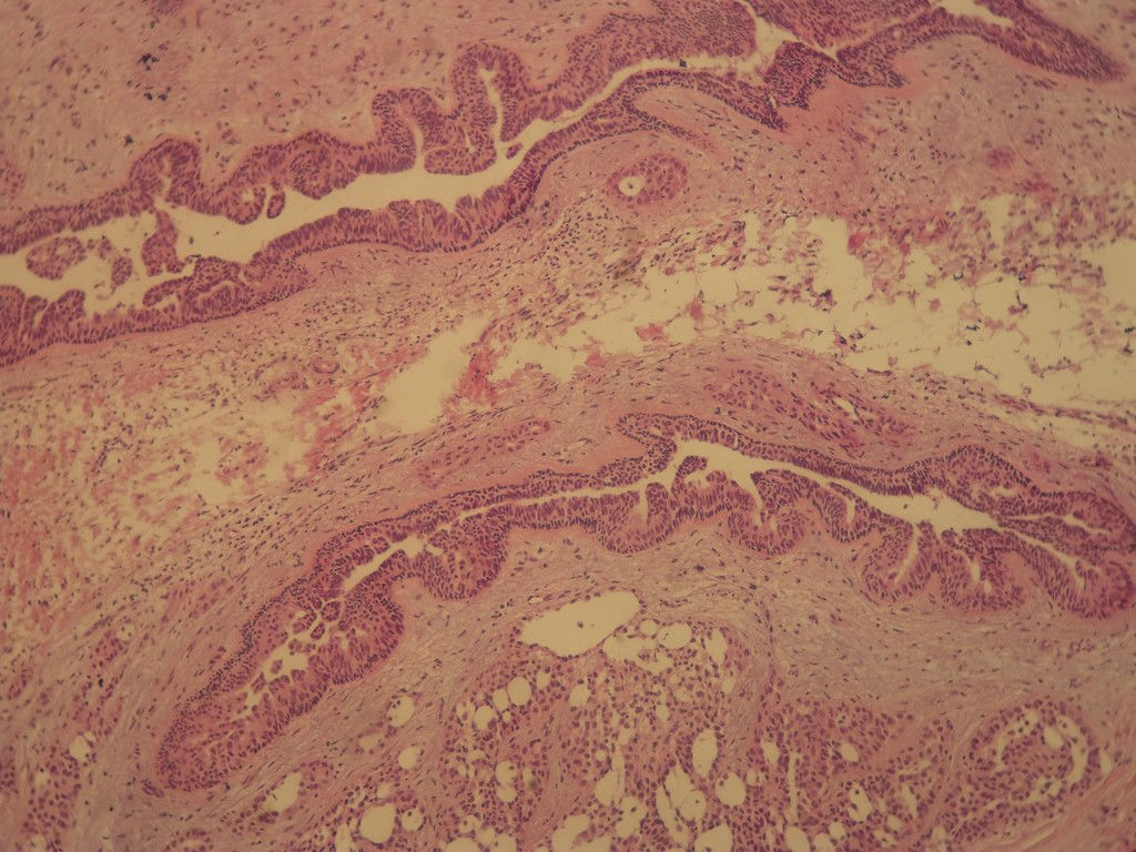 腺病？癌？其他？(12楼常规，24楼免疫组化及会诊结果)图7