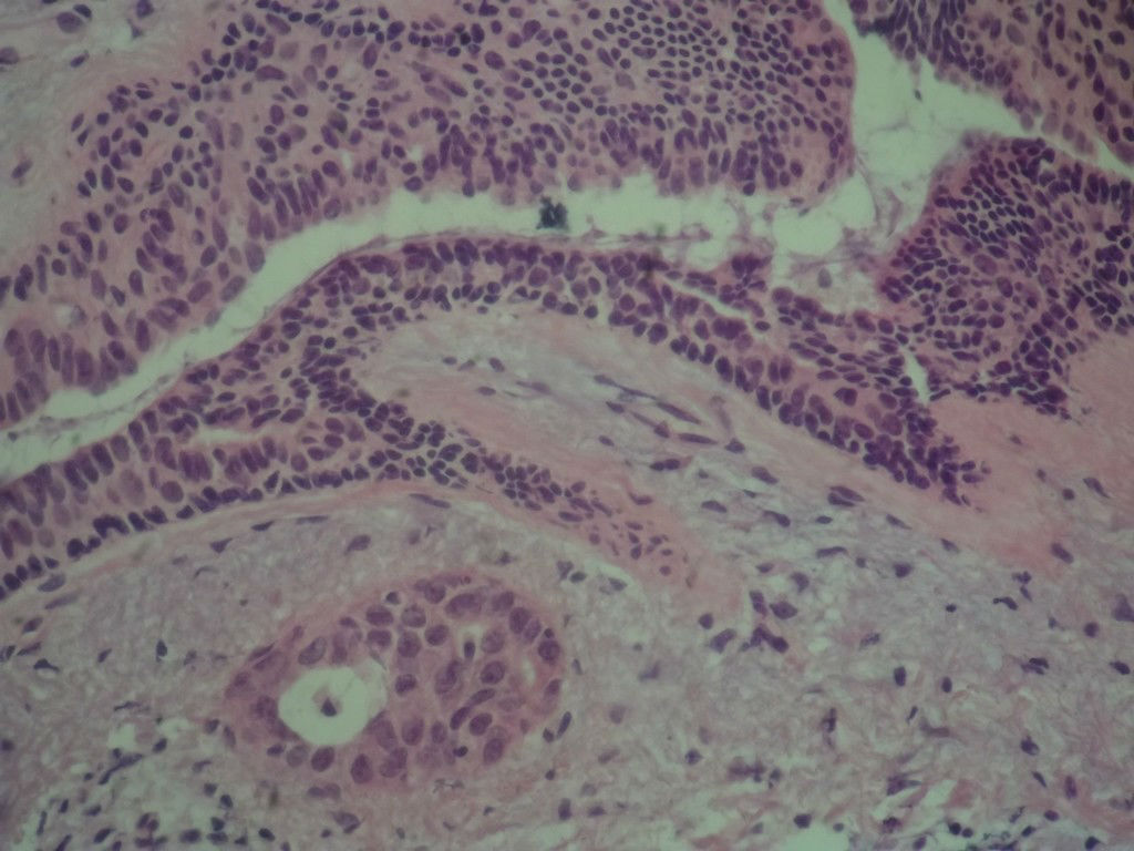 腺病？癌？其他？(12楼常规，24楼免疫组化及会诊结果)图8