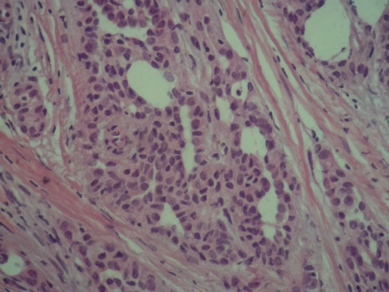 腺病？癌？其他？(12楼常规，24楼免疫组化及会诊结果)图10