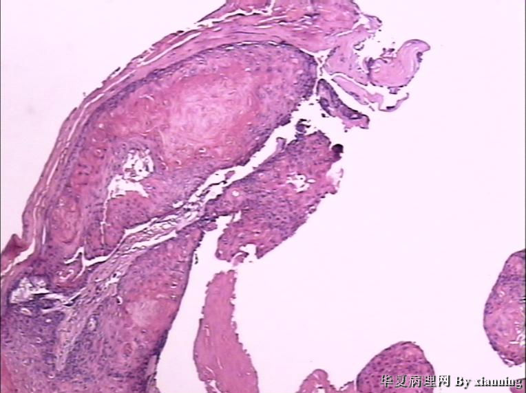 女 50岁 头皮下肿块图1 女 50岁 头皮下肿块图1