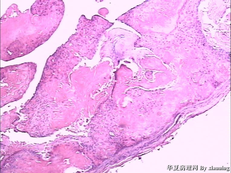 女 50岁 头皮下肿块图2 女 50岁 头皮下肿块图2