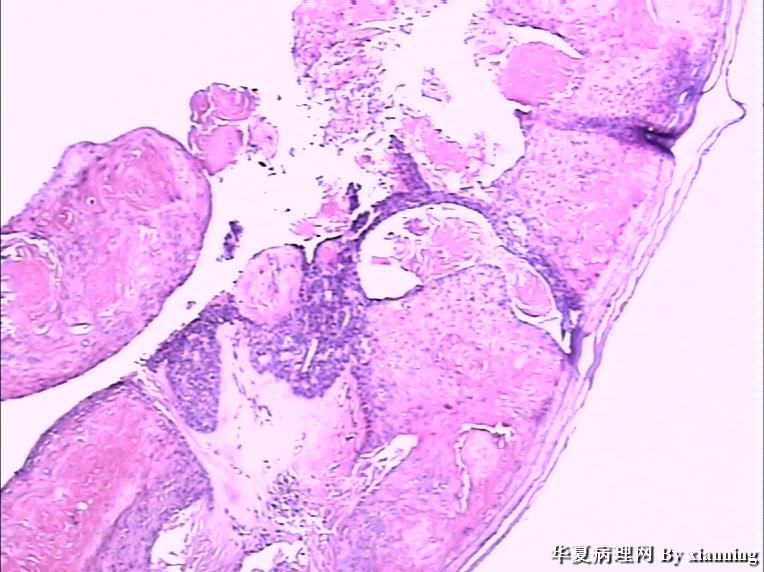 女 50岁 头皮下肿块图3 女 50岁 头皮下肿块图3