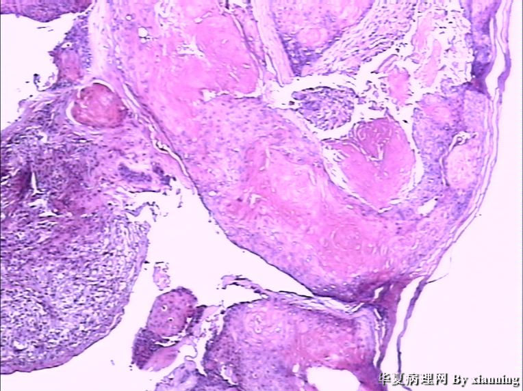 女 50岁 头皮下肿块图4 女 50岁 头皮下肿块图4