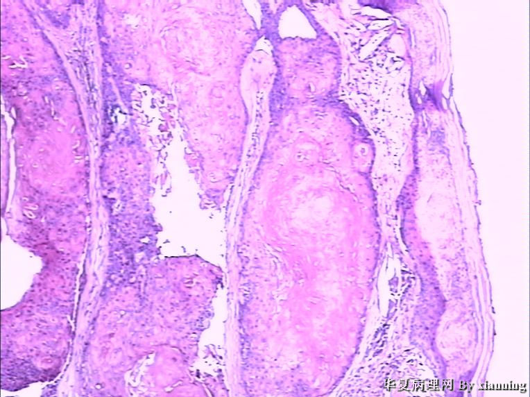 女 50岁 头皮下肿块图5 女 50岁 头皮下肿块图5