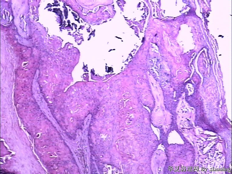 女 50岁 头皮下肿块图6 女 50岁 头皮下肿块图6