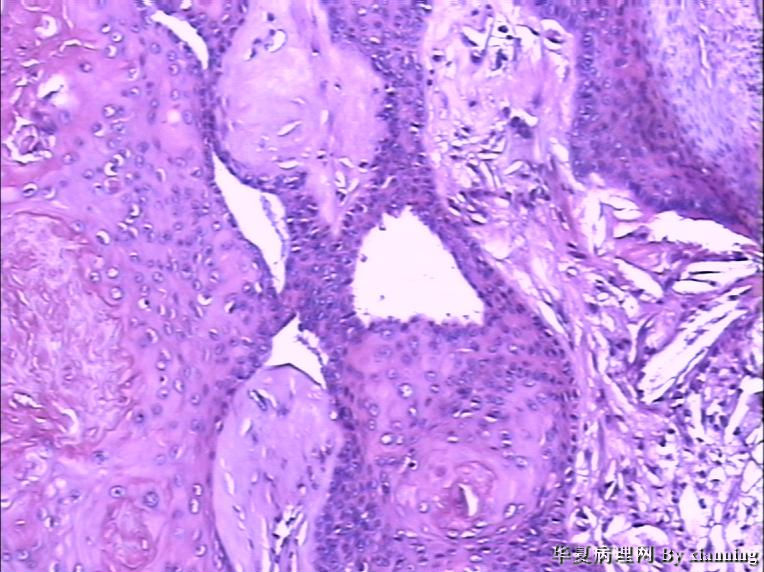 女 50岁 头皮下肿块图7 女 50岁 头皮下肿块图7
