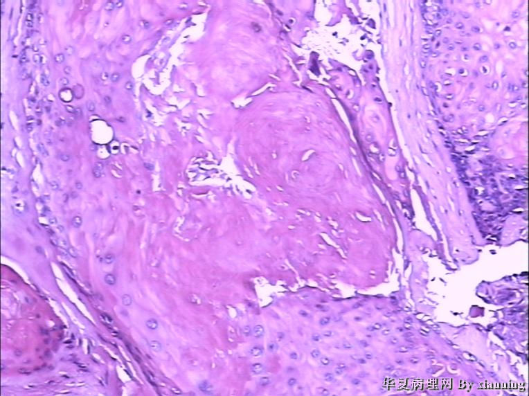 女 50岁 头皮下肿块图8 女 50岁 头皮下肿块图8