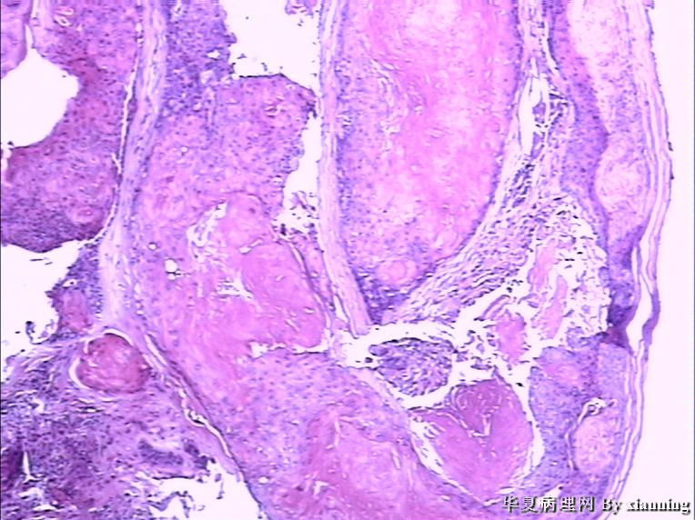 女 50岁 头皮下肿块图9 女 50岁 头皮下肿块图9