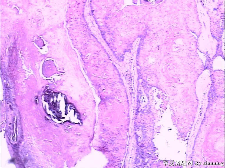 女 50岁 头皮下肿块图10 女 50岁 头皮下肿块图10