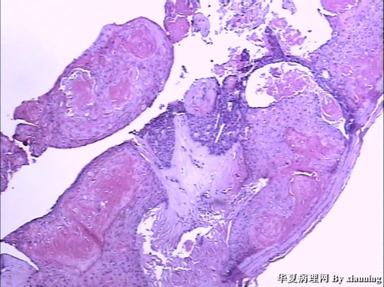 女 50岁 头皮下肿块图11 女 50岁 头皮下肿块图11