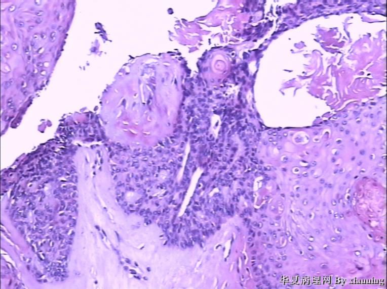 女 50岁 头皮下肿块图12 女 50岁 头皮下肿块图12