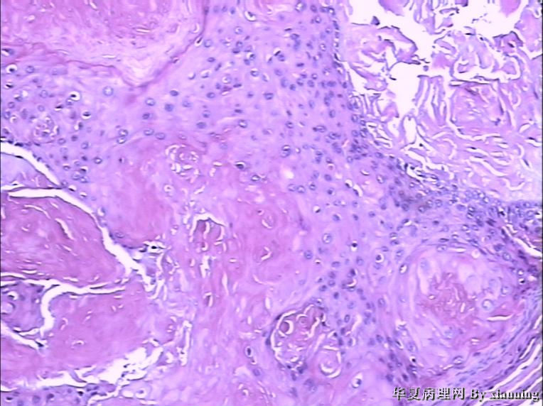 女 50岁 头皮下肿块图13 女 50岁 头皮下肿块图13