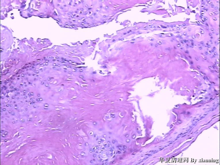 女 50岁 头皮下肿块图14 女 50岁 头皮下肿块图14