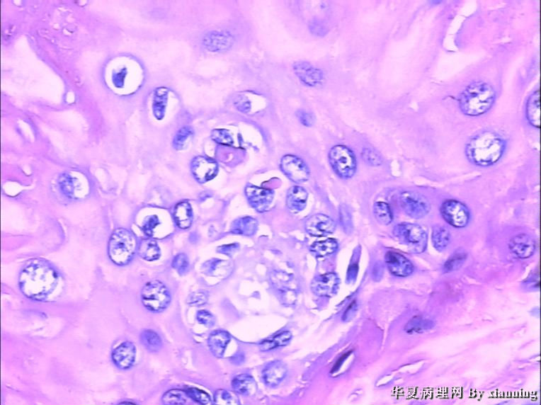 女 50岁 头皮下肿块图15 女 50岁 头皮下肿块图15