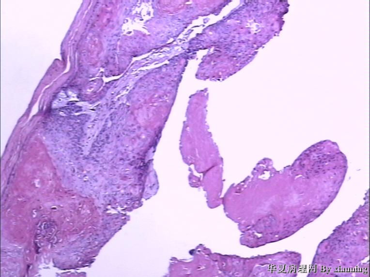 女 50岁 头皮下肿块图16 女 50岁 头皮下肿块图16