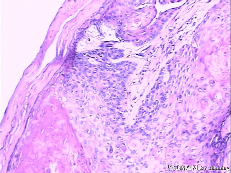 女 50岁 头皮下肿块图17 女 50岁 头皮下肿块图17