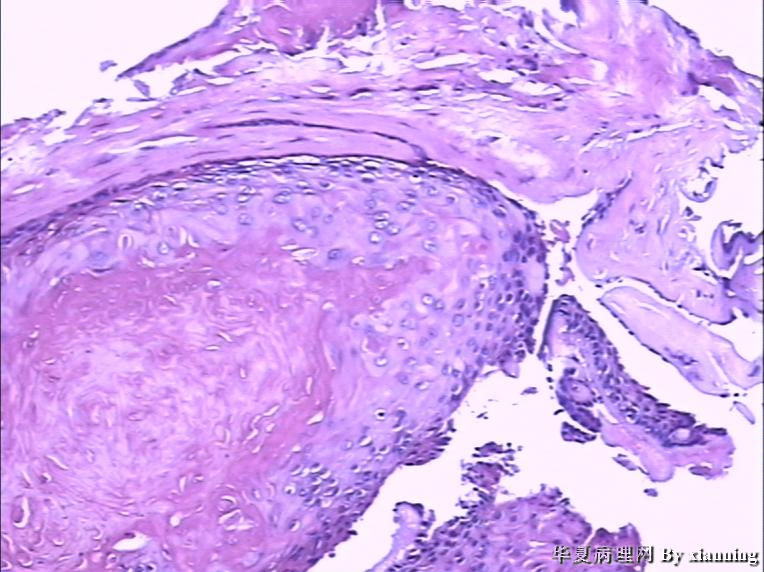 女 50岁 头皮下肿块图18 女 50岁 头皮下肿块图18