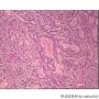 胆囊癌，透明细胞癌？图8