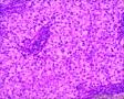 分享！乳腺透明细胞癌图10