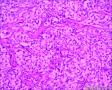 分享！乳腺透明细胞癌图14
