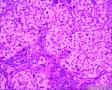 分享！乳腺透明细胞癌图12