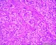 分享！乳腺透明细胞癌图13