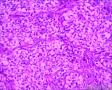 分享！乳腺透明细胞癌图19