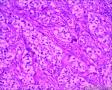 分享！乳腺透明细胞癌图20