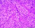 分享！乳腺透明细胞癌图18