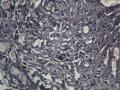 胃镜（胃体、胃窦）肉芽组织中成纤维细胞核特大、有核分裂，请专家们看看有无异型上皮细胞。图17