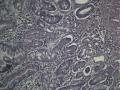 胃镜（胃体、胃窦）肉芽组织中成纤维细胞核特大、有核分裂，请专家们看看有无异型上皮细胞。图11