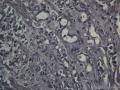 胃镜（胃体、胃窦）肉芽组织中成纤维细胞核特大、有核分裂，请专家们看看有无异型上皮细胞。图15