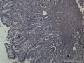 胃镜（胃体、胃窦）肉芽组织中成纤维细胞核特大、有核分裂，请专家们看看有无异型上皮细胞。图10
