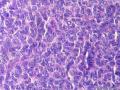 经典病例学习-卵巢成人型颗粒细胞瘤图8