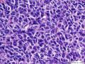 经典病例学习-卵巢成人型颗粒细胞瘤图9
