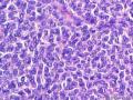 经典病例学习-卵巢成人型颗粒细胞瘤图12