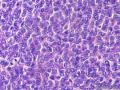 经典病例学习-卵巢成人型颗粒细胞瘤图11