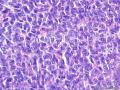 经典病例学习-卵巢成人型颗粒细胞瘤图7