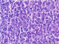 经典病例学习-卵巢成人型颗粒细胞瘤图10