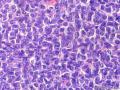 经典病例学习-卵巢成人型颗粒细胞瘤图13