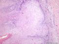 经典病例学习-阴茎疣状癌图13