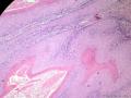经典病例学习-阴茎疣状癌图12