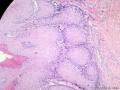 经典病例学习-阴茎疣状癌图11