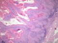 经典病例学习-阴茎疣状癌图5