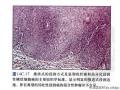 经典病例学习-阴茎疣状癌图18